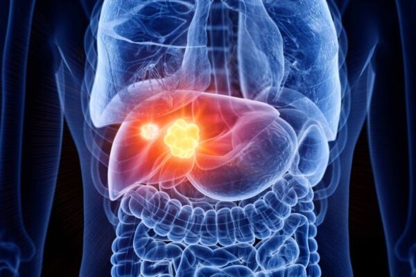 Liver Health: లివర్ ట్యూమర్ లక్షణాలు.. ముందుగానే గుర్తిస్తే ప్రాణాపాయం తప్పుతుంది..!